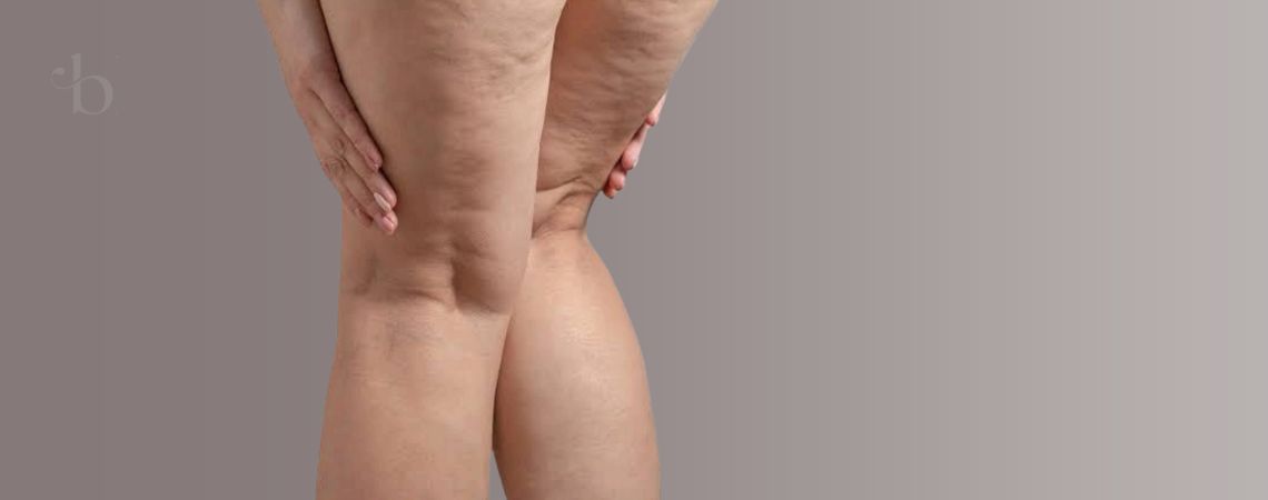 Lipedema Blissa